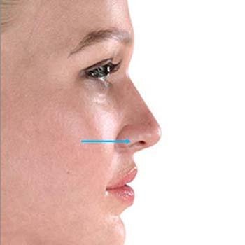 After ofRhinoplasty