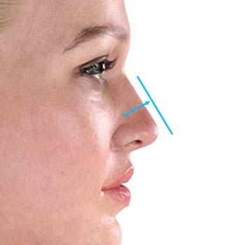 After ofRhinoplasty